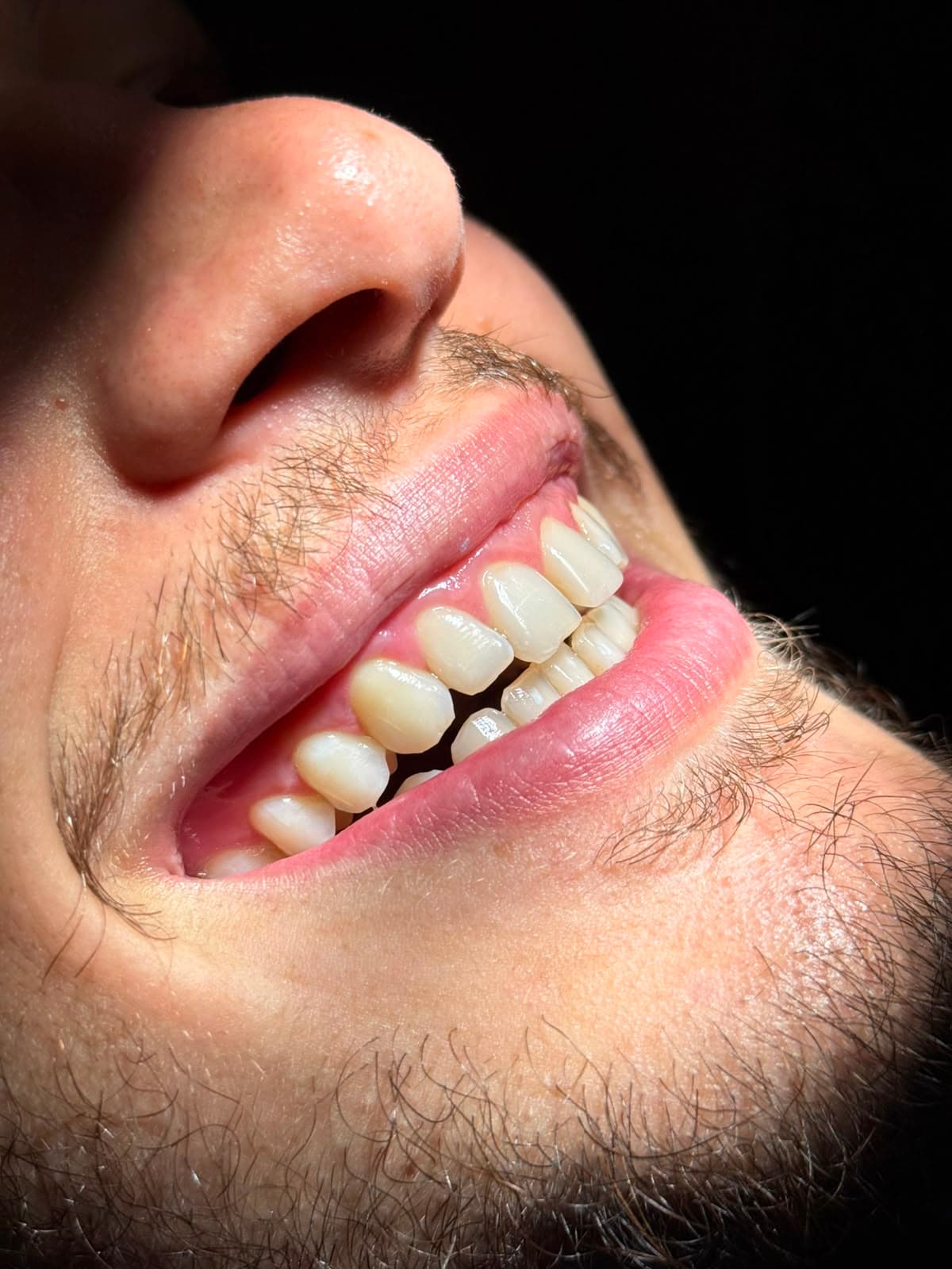 Sorriso antes do clareamento dental na Clínica Cler